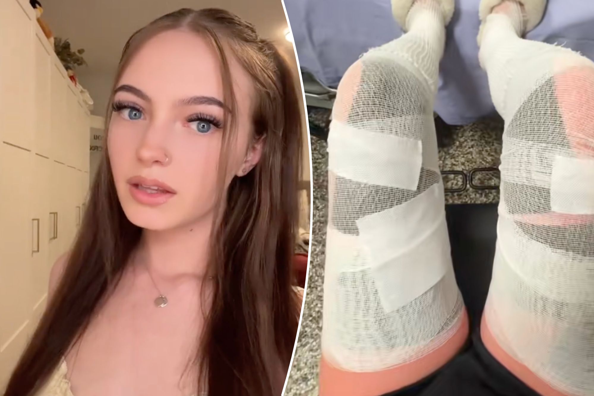 The woman left with third grade burns and unable to walk for a week reveals her main mistake: "I will never forget"